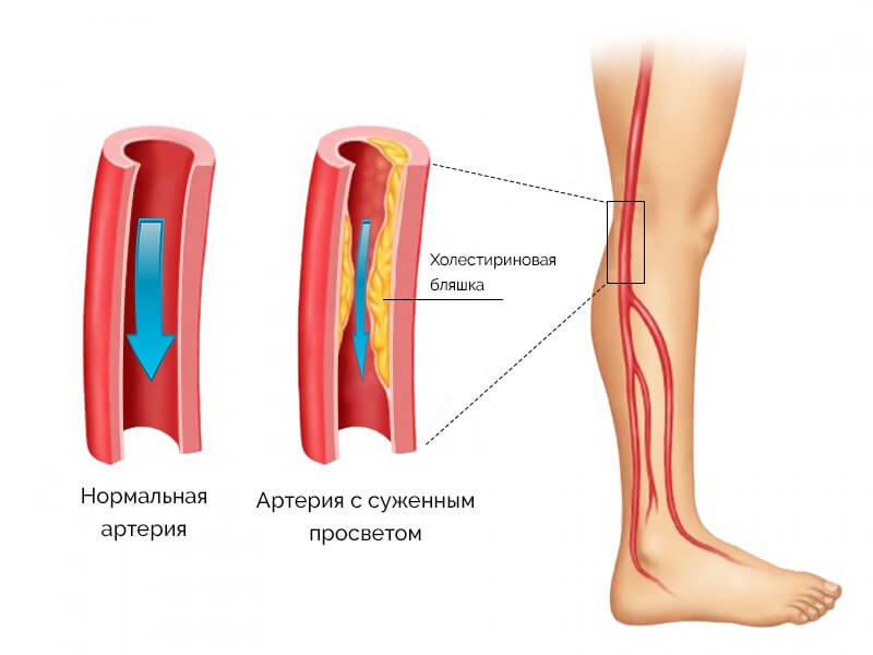 МСКТ артерий нижних конечностей