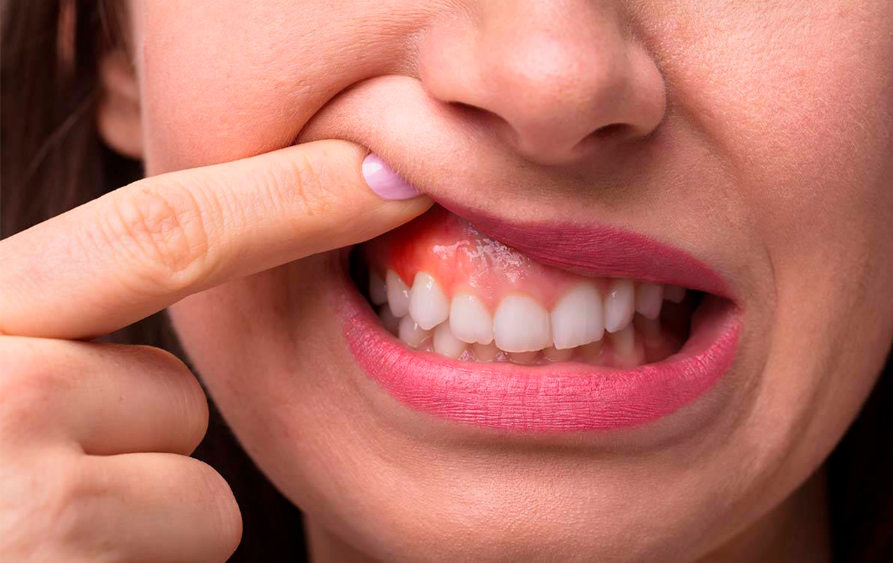 Гной после удаления зуба - что делать | Стоматология «Денталюкс-М» (Москва)